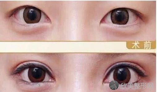 上海市第一人民医院整形科双眼皮术前术后对比图