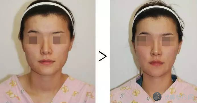 上海伊莱美容医疗美容医院下颌角术前术后对比图