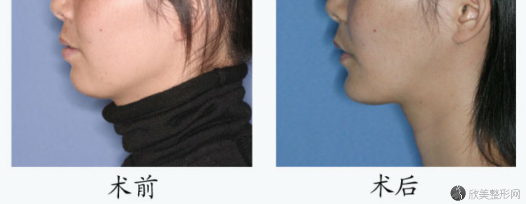 同济大学附属口腔医院正颌术前术后对比图