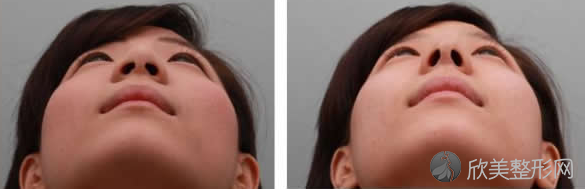 重庆西南医院整形外科鼻尖塑型