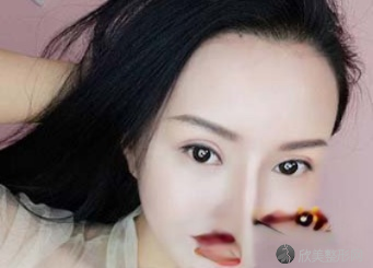 郑大二附院杨丽双眼皮怎么样?术前术后图-价格表一览