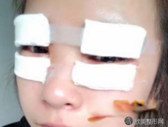 郑大二附院杨丽双眼皮怎么样?术前术后图-价格表一览