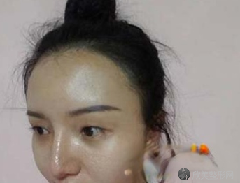 郑大二附院杨丽双眼皮怎么样?术前术后图-价格表一览