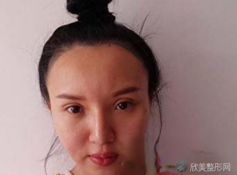 郑大二附院杨丽双眼皮怎么样?术前术后图-价格表一览