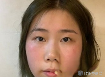 西安西京马显杰双眼皮怎么样?术前术后图-收费标准一览
