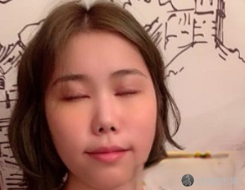 西安西京马显杰双眼皮怎么样?术前术后图-收费标准一览