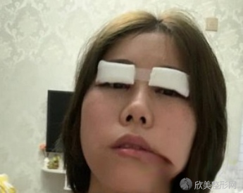 西安西京马显杰双眼皮怎么样?术前术后图-收费标准一览