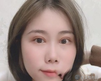 西安西京马显杰双眼皮怎么样?术前术后图-收费标准一览