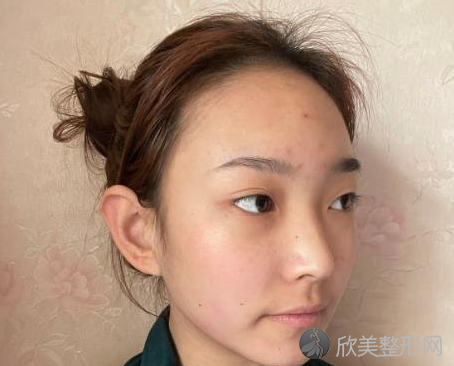 广州美恩磨骨三个月术前术后图,全新磨骨价格表