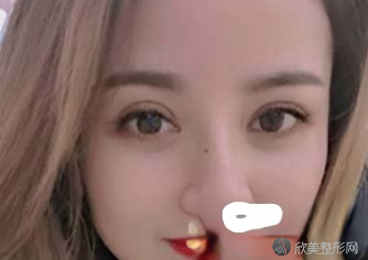 上海首尔丽格朴相根双眼皮怎么样?顾客术后反馈-收费标准公布