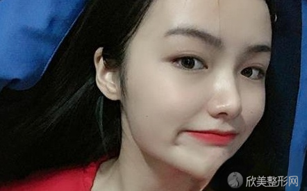 广州曙光隆鼻怎么样?顾客术前术后图-参考价格出炉