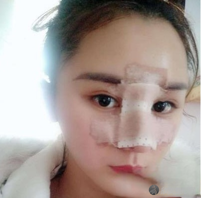 上海九院整形外科隆鼻案例
