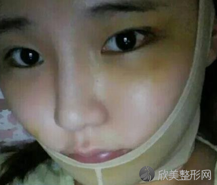 北京八大处整形医院靳小雷磨骨案例
