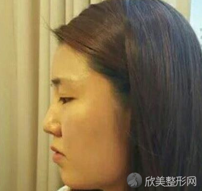 北京八大处整形医院靳小雷磨骨案例
