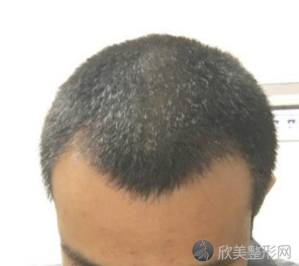 北京男性植发