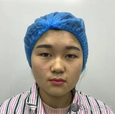 西安国际医学中心医院孙峰双眼皮修复