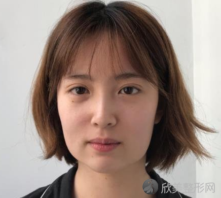 磨骨术前术后对比图