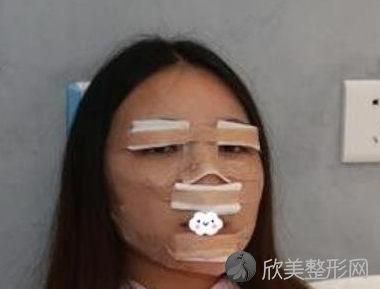 北京第一联合丽格双眼皮