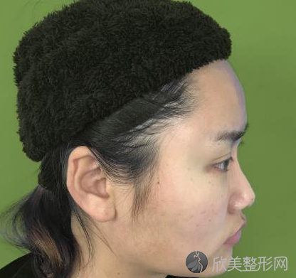 北京新星靓隆鼻术前术后对比图