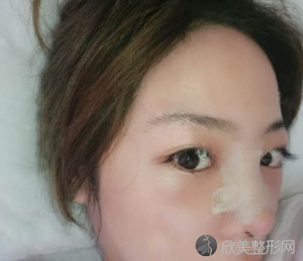 成都西区医院邓东伟做鼻子怎么样-术后案例-价格表