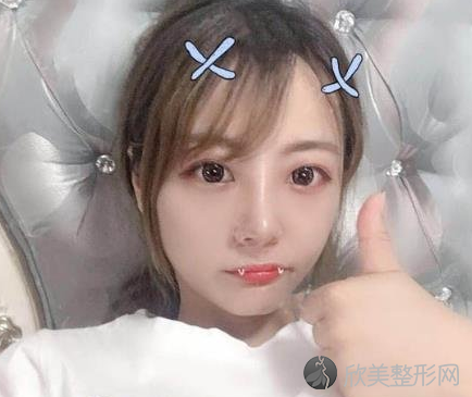 成都西区医院邓东伟做鼻子怎么样-术后案例-价格表