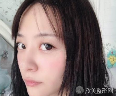 成都西区医院邓东伟做鼻子怎么样-术后案例-价格表