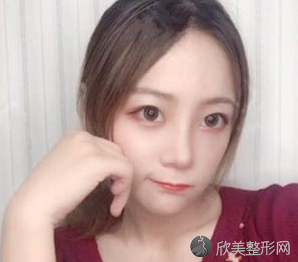 成都西区医院邓东伟做鼻子怎么样-术后案例-价格表