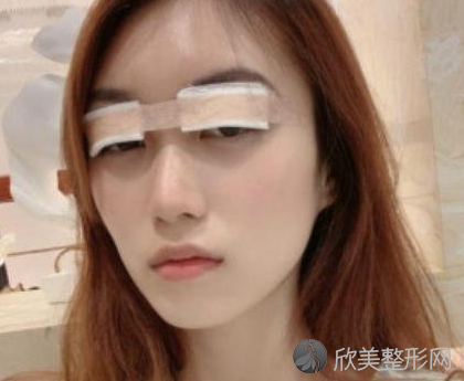 成都八大处是三甲吗-正规吗-收费价目表-双眼皮案例