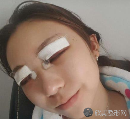 成都素美医疗美容医院怎么样-杨迪双眼皮-收费标准-案例