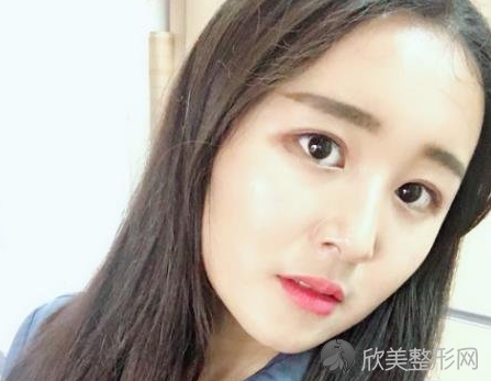 成都素美医疗美容医院怎么样-杨迪双眼皮-收费标准-案例