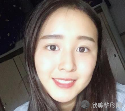 成都素美医疗美容医院怎么样-杨迪双眼皮-收费标准-案例