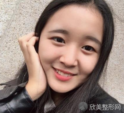 成都素美医疗美容医院怎么样-杨迪双眼皮-收费标准-案例