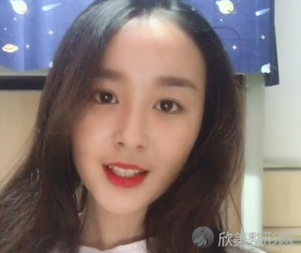 成都素美医疗美容医院怎么样-杨迪双眼皮-收费标准-案例