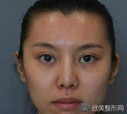成都友谊医院李萍隆鼻怎么样-真实案例反馈--较近价格表
