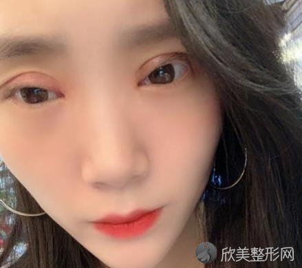 成都西区邓东伟做双眼皮怎么样-案例反馈-收费标准
