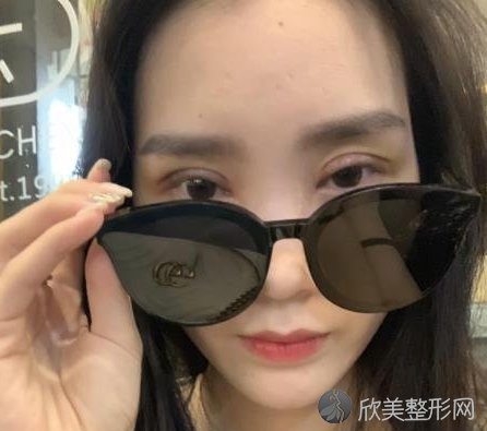 成都西区邓东伟做双眼皮怎么样-案例反馈-收费标准