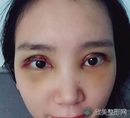 成都西区邓东伟做双眼皮怎么样-案例反馈-收费标准