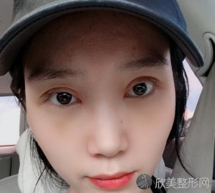 成都西区邓东伟做双眼皮怎么样-案例反馈-收费标准