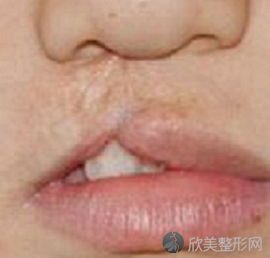 北京协和医院整形科兔唇修复靠谱吗-案例-收费标准