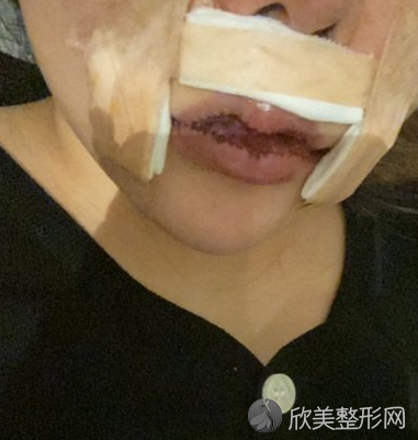 北京协和医院整形科兔唇修复靠谱吗-案例-收费标准