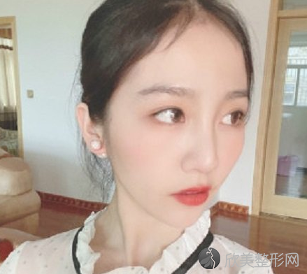北京八大处刘敦隆鼻怎么样-术后案例-全新价格表