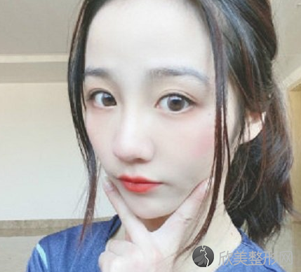 北京八大处刘敦隆鼻怎么样-术后案例-全新价格表