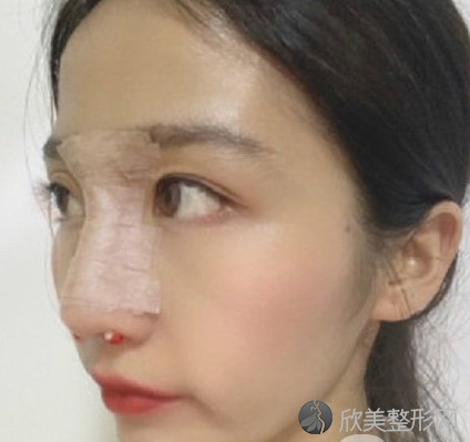 北京八大处刘敦隆鼻怎么样-术后案例-全新价格表