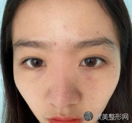 北京八大处刘敦隆鼻怎么样-术后案例-全新价格表