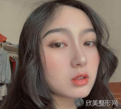 北大口腔医院李自力正颌怎么样-术后案例分享-收费标准