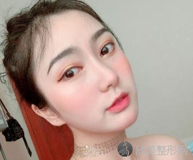 北大口腔医院李自力正颌怎么样-术后案例分享-收费标准