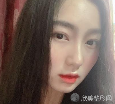 北大口腔医院李自力正颌怎么样-术后案例分享-收费标准