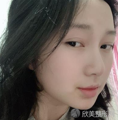北大口腔医院李自力正颌怎么样-术后案例分享-收费标准