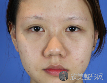 上海九院隆鼻术后三个月真实反馈-2021价格表更新
