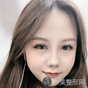 上海九院隆鼻术后三个月真实反馈-2021价格表更新